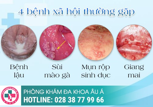 
						Nổi Mụn Ở Vùng Kín Là Bệnh Gì