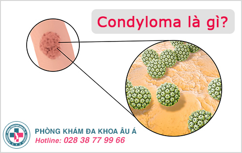 
						Bệnh Condyloma và những nguy hiểm không thể xem thường