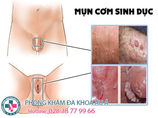 6. Phòng Ngừa Mụn Cơm Hoa Liễu Ở Hậu Môn