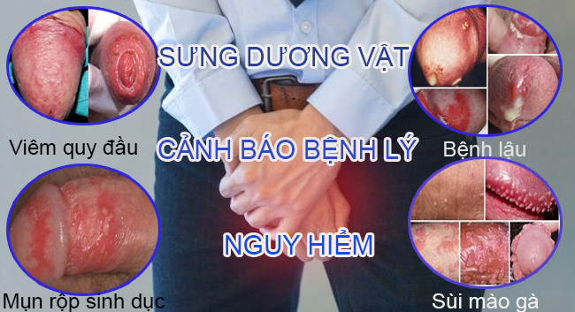 
						Dương Vật Bị Sưng – Có Phải Tôi Đã Mắc Bệnh?