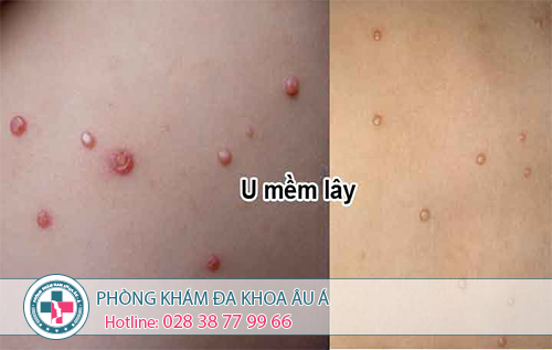 
						Bệnh U Mềm Lây – Triệu Chứng Và Cách Điều Trị