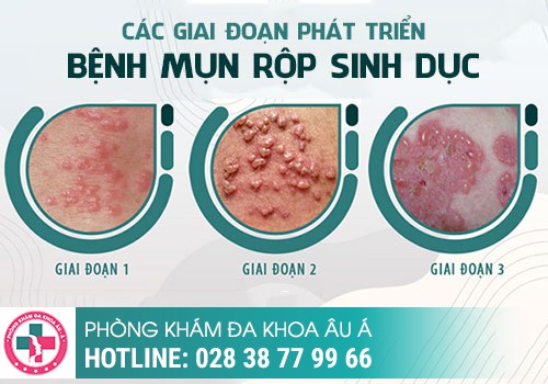 
						Hình ảnh mụn rộp sinh dục giai đoạn đầu thường gặp