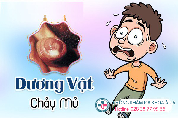 
						Dương Vật Chảy Mủ - Cảnh Báo 3 Bệnh Lý Nguy Hiểm