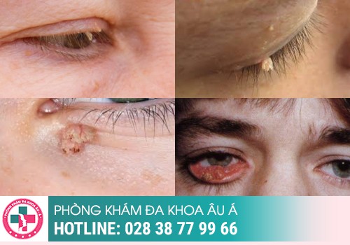 
						Sùi Mào Gà Ở Mắt Rất Nguy Hiểm Có Nguy Cơ Gây Mù Lòa