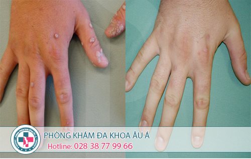 
						Điều trị sùi mào gà