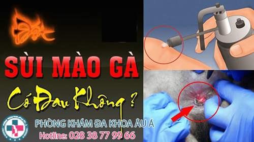 
						Đốt Sùi Mào Gà Và Những Thông Tin Cần Biết