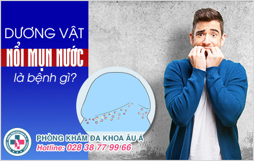 
						Dương vật nổi mụn nước là bị gì?