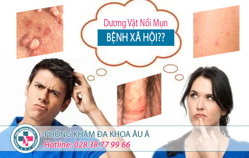 
						Dương Vật Nổi Mụn, Tưởng Viêm Nhiễm Bình Thường Hóa Ra bệnh xã hội