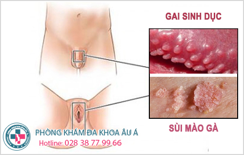 
						Thăm Khám Và Điều Trị Sớm Gai Sinh Dục Với Gói Combo Chỉ 200K