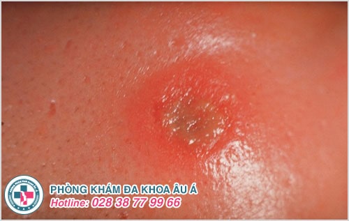 Thuốc điều trị bệnh giang mai có những loại nào? Hiệu quả ra sao? Thuốc điều trị bệnh giang mai có những loại nào? Hiệu quả ra sao?