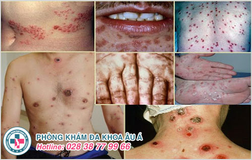 Thuốc điều trị bệnh giang mai có những loại nào? Hiệu quả ra sao? Thuốc điều trị bệnh giang mai có những loại nào? Hiệu quả ra sao?