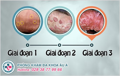 Sùi mào gà Sùi mào gà
