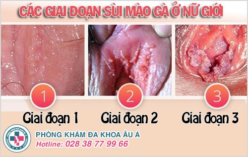 Sùi mào gà Sùi mào gà