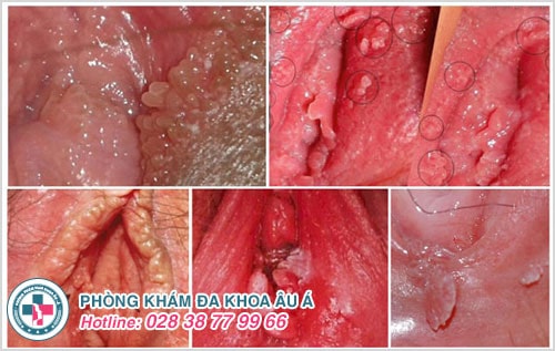 Bệnh viện da liễu chữa sùi mào gà Bệnh viện da liễu chữa sùi mào gà