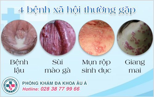 bệnh stds bệnh stds