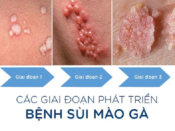 Sùi mào gà - Bệnh dễ lây nhiễm nhưng khó điều trị Sùi mào gà - Bệnh dễ lây nhiễm nhưng khó điều trị