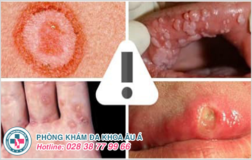 Dấu hiệu bệnh giang mai Dấu hiệu bệnh giang mai