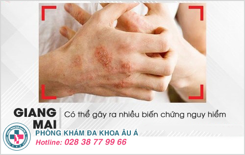 Dấu hiệu bệnh giang mai Dấu hiệu bệnh giang mai