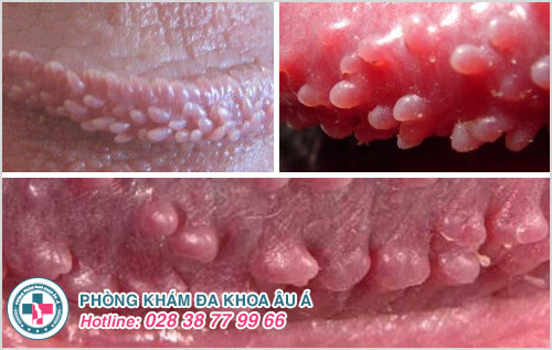 hình ảnh gai sinh dục
