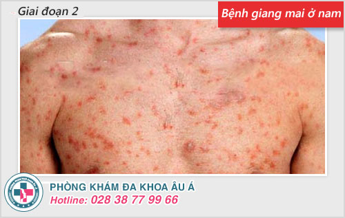 Chi tiết hình ảnh bệnh giang mai ở nam, nữ qua từng giai đoạn