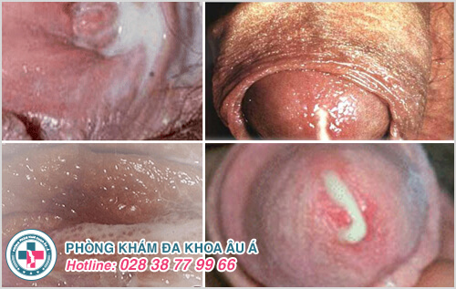 Cận cảnh hình ảnh bệnh lậu ở các vị trí trên cơ thể Cận cảnh hình ảnh bệnh lậu ở các vị trí trên cơ thể