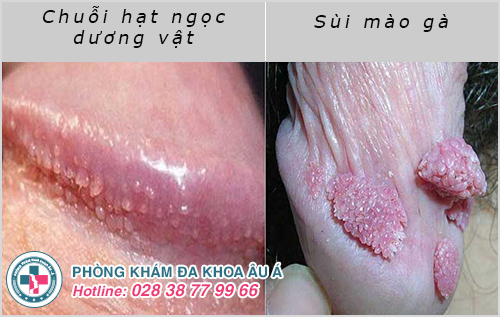 Hình ảnh hạt ngọc dương vật Hình ảnh hạt ngọc dương vật