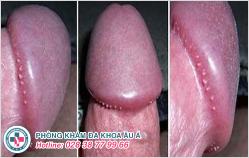 Hình ảnh hạt ngọc dương vật Hình ảnh hạt ngọc dương vật