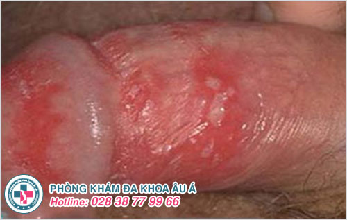 Mụn rộp sinh dục