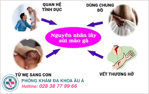 Nguyên nhân triệu chứng sùi mào gà và cách chữa Nguyên nhân triệu chứng sùi mào gà và cách chữa
