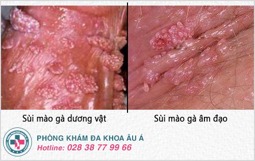Nguyên nhân triệu chứng sùi mào gà và cách chữa Nguyên nhân triệu chứng sùi mào gà và cách chữa