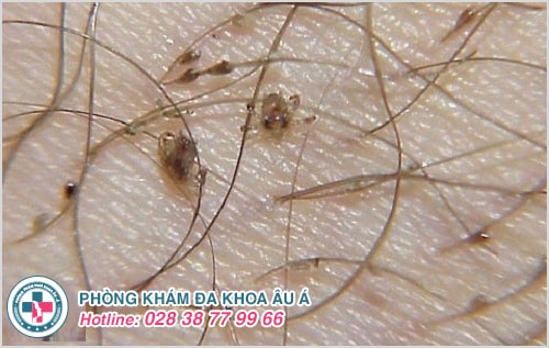 Thuốc trị rận mu loại nào tốt và hiệu quả nhất? Thuốc trị rận mu loại nào tốt và hiệu quả nhất?