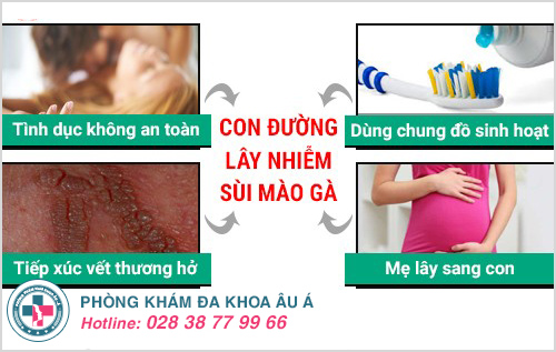 Sùi mào gà có lây hay không? Sùi mào gà có lây hay không?