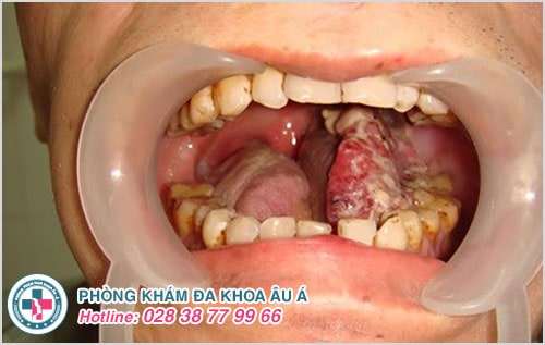 dấu hiệu sùi mào gà ở miệng dấu hiệu sùi mào gà ở miệng