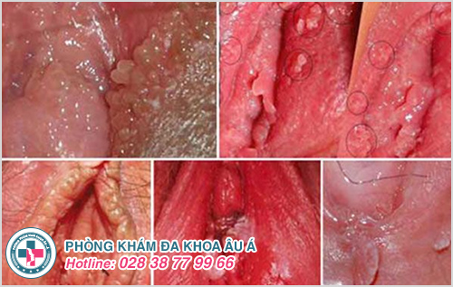 Nỗi lo khi xuất hiện thịt dư âm đạo Nỗi lo khi xuất hiện thịt dư âm đạo
