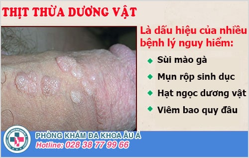 Nam giới cần cảnh giác với thịt thừa dương vật Nam giới cần cảnh giác với thịt thừa dương vật