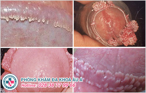 Nam giới cần cảnh giác với thịt thừa dương vật Nam giới cần cảnh giác với thịt thừa dương vật