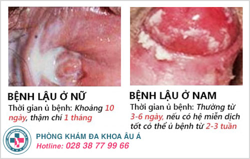 thời gian ủ bệnh lậu thời gian ủ bệnh lậu