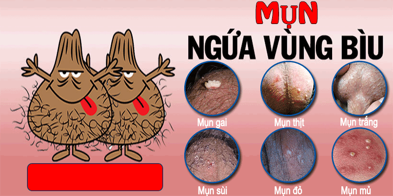 
						Tôi Đã Chữa Khỏi Nổi Mụn Tinh Hoàn Bằng Cách Sau