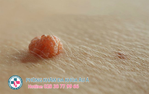 
						Mụn cóc sinh dục có phải sùi mào gà không?