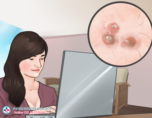 
						Nổi Mụn Hậu Môn – Sùi Mào Gà Hay Mụn Bình Thường