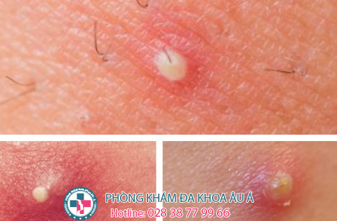 
						Mụn Nhọt Ở Háng Và Những Nguy Hiểm Đằng Sau, Đừng Chủ Quan