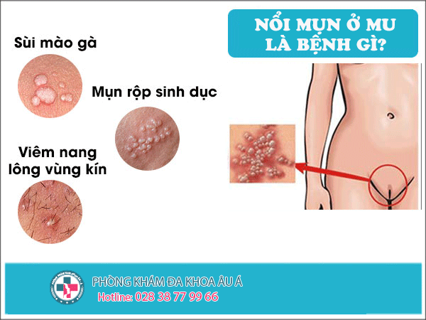 
						Nổi Mụn Ở Mu - Nguyên Nhân Và Cách Điều Trị Hiệu Quả
