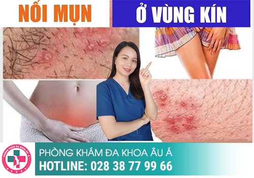 
						Nổi Mụn Bọc Ở Vùng Kín Có Sao Không?