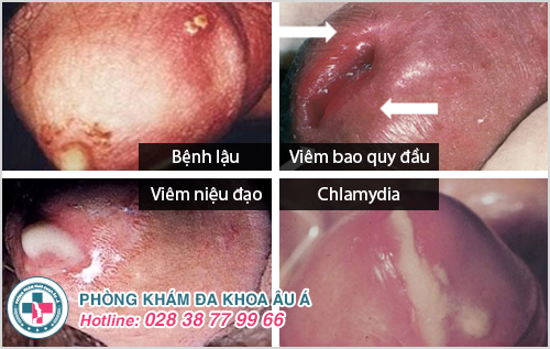 4 nguyên nhân khiến cậu nhỏ chảy mủ bạn cần biết 4 nguyên nhân khiến cậu nhỏ chảy mủ bạn cần biết