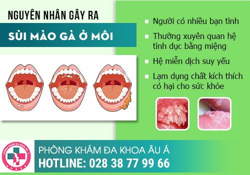 
						Tổng Quan Về Bệnh Sùi Mào Gà Ở Môi