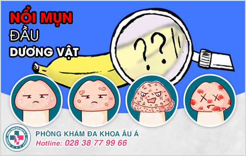 
						Nổi Mụn Đầu Dương Vật - Dấu Hiệu Nguy Hiểm Dễ Bị Bỏ Qua