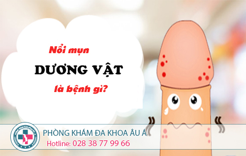 
						Nổi Mụn Dương Vật - Dấu Hiệu Đầu Của bệnh xã hội