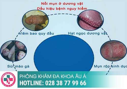 
						Dương Vật Nổi Mụn Thịt Là Bị Bệnh Gì?