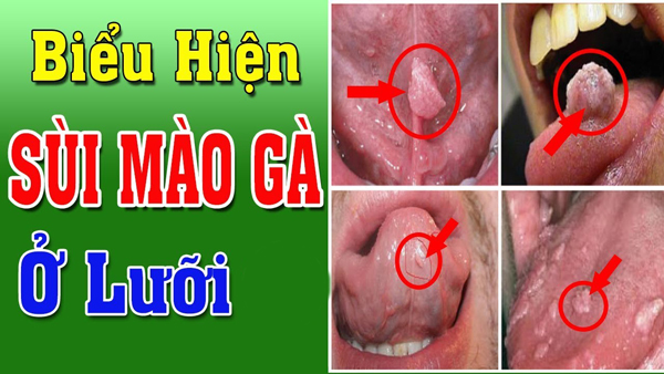 
						Sùi Mào Gà Ở Lưỡi – Nguyên Nhân Và Cách Điều Trị Hiệu Qủa