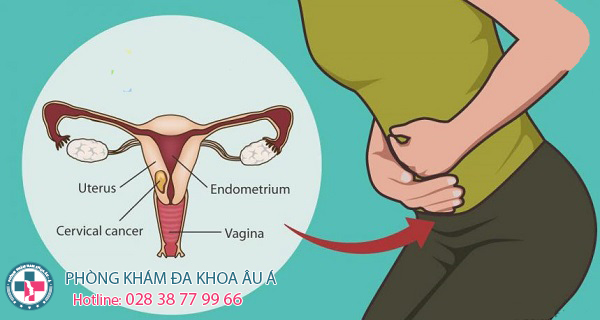 
						TRIỆU CHỨNG SÙI MÀO GÀ Ở CỔ TỬ CUNG